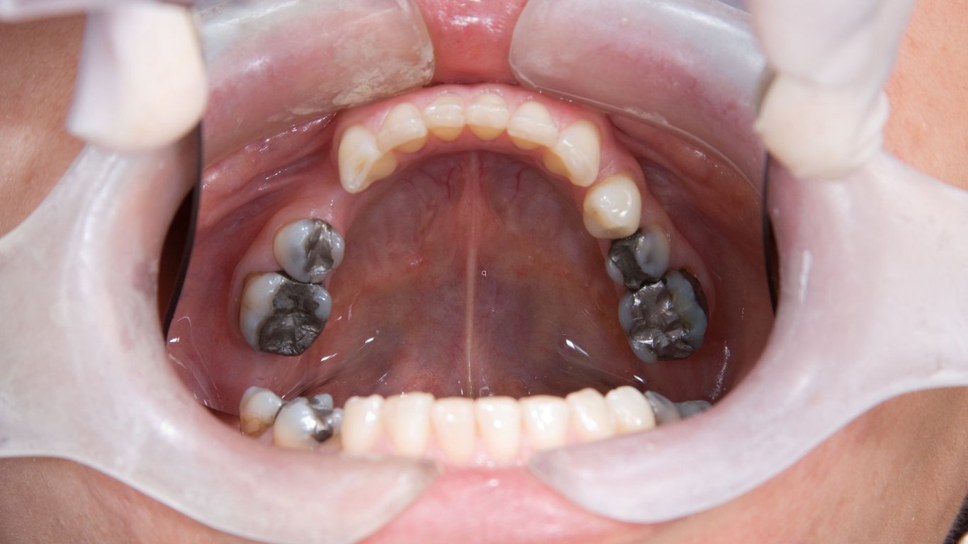 Does Vaping Stain Teeth