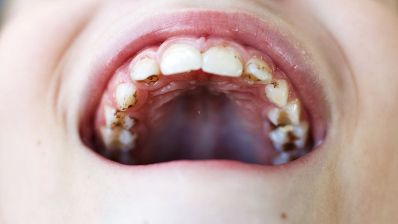 Does Vaping Stain Teeth?
